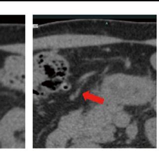 Measuring the right gastroepiploic artery (GEA) on computed tomography ...