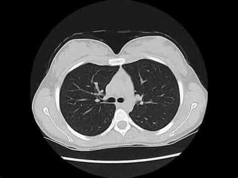 Normal Chest CT - using "lung windows" - YouTube