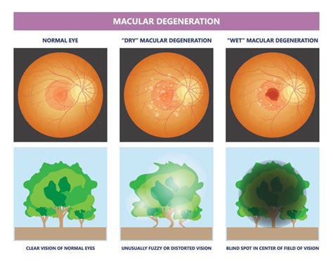 Understanding Age-Related Macular Degeneration - Ask The Nurse Expert