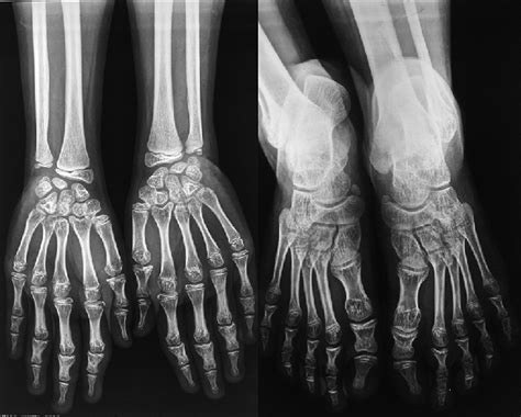 X‑ray showing angulation of the phalanges | Download Scientific Diagram