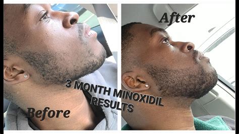 3 MONTH MINOXIDIL BEARD GROWTH RESULTS (TIPS AND TRICKS TO SPEED UP GROWTH) - YouTube