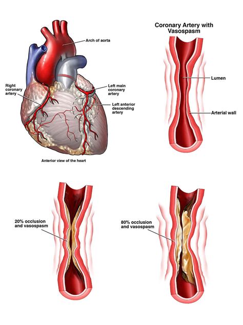 Coronary Heart Disease | NHLBI, NIH