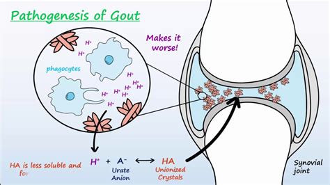 Gout - Mechanisms & Treatment - YouTube