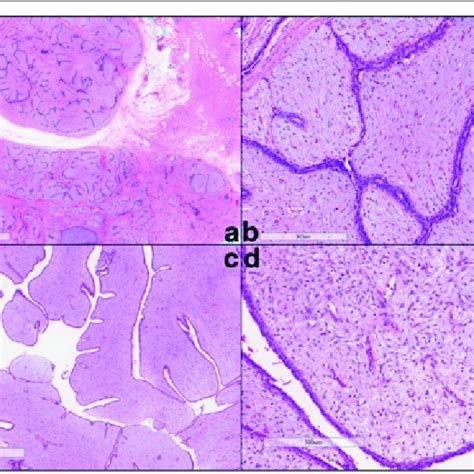 Histology of fibroadenoma and phyllodes tumor on surgical excisions. a,... | Download Scientific ...