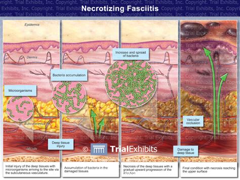 Necrotizing Fasciitis - TrialQuest Inc.