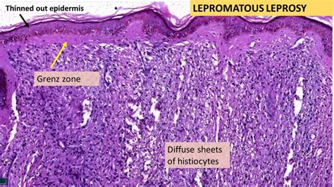 LEPROSY- Tuberculoid & Lepromatous - Pathology Made Simple