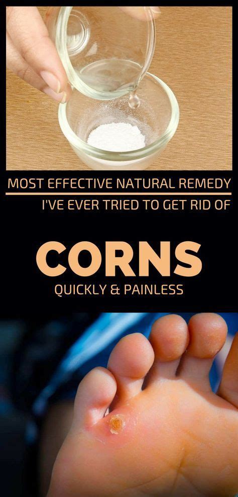 Most Effective Natural Remedy I’ve Ever Tried To Get Rid Of Corns Quickly And Painless | Get rid ...