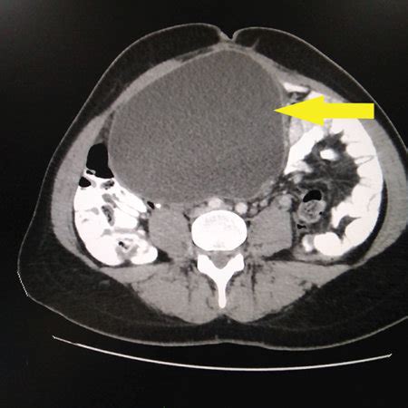 CT scan of the mesenteric cyst (arrow). | Download Scientific Diagram