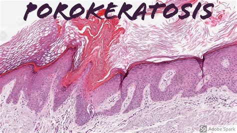 Epidermodysplasia Verruciformis Histology