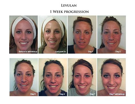 Photodynamic Therapy PDT San Diego, CA | Cosmetic Laser Dermatology