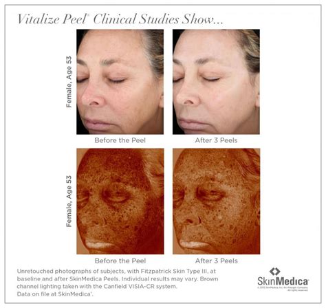 Reveal Beautiful New Skin w/ Chemical Peels - Benessere Clinic