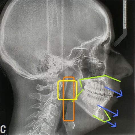 Hilary's Broken Face: Lateral Ceph X-ray with Soft Tissue