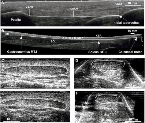 Achilles Tendon Anatomy Ultrasound