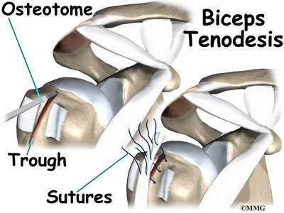 Biceps Rupture | Orthogate