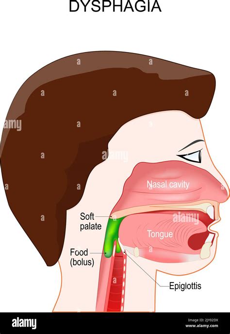 Epiglottis Pictures For Kids