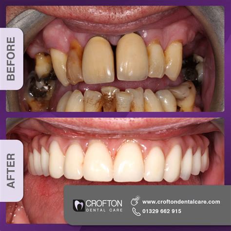 All-on-6 Dental Implants | Crofton Dental Care