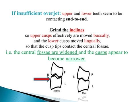 occlusal adjustment | PPT