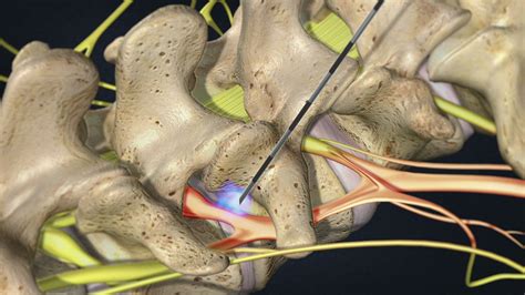 Watch: Lumbar Transforaminal Epidural Steroid Injection