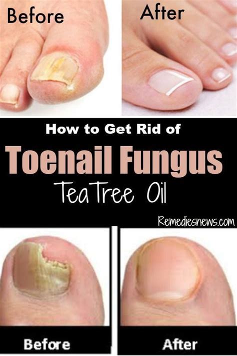 How to Get Rid of Toenail Fungus, before and after, with Tea Tree Oil ...