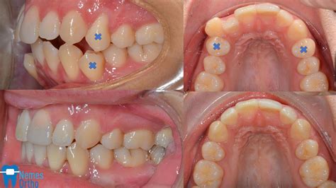 Comprehensive orthodontic treatment with extraction of 4️⃣ premolars