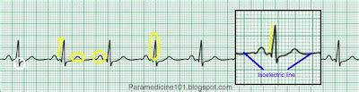 The Electrocardiogram - Part III | Paramedicine 101