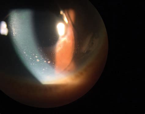 Lesson: What to Do When You See Uveitis