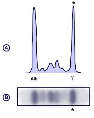 Serum Protein Electrophoresis: Reference Range, Interpretation ...