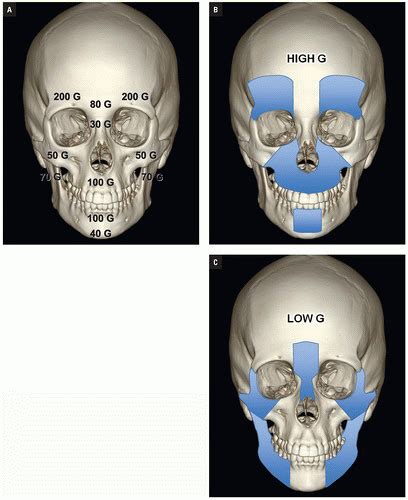 Imaging Maxillofacial Trauma | Radiology Key