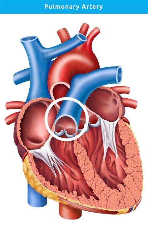 Pulmonary Artery Stenting | Professor Kevin P Walsh