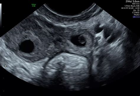 Ultrasound for Ectopic Pregnancy Sydney | Ultrasound Care