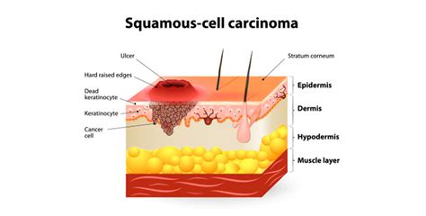 Squamous Cell Carcinoma Skin Cancer Symptoms