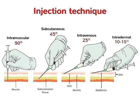 Injection types : r/coolguides