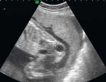 Sacrococcygeal Teratoma and Fetus in Fetu | Radiology Key