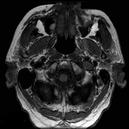 Jugular Foramen Mri