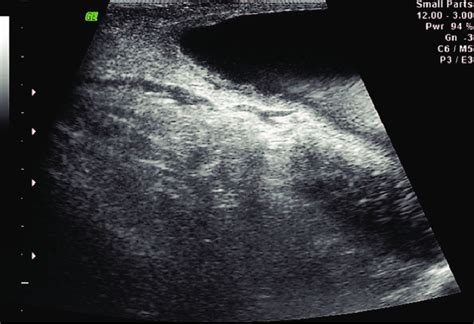 Ultrasonography image of a subcutaneous anechoic, fluid filled mass... | Download Scientific Diagram