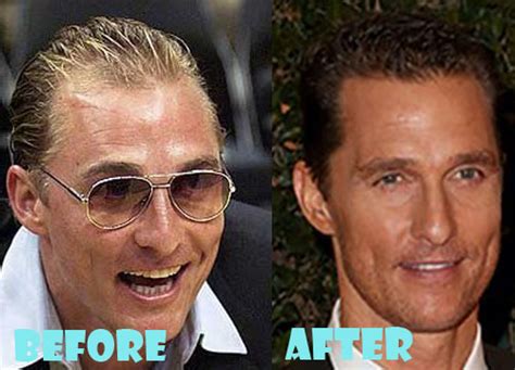 Matthew Mcconaughey Plastic Surgery Before and After Picture - Lovely ...