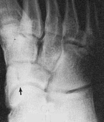 Tarsal Navicular Fractures - Foot & Ankle - Orthobullets