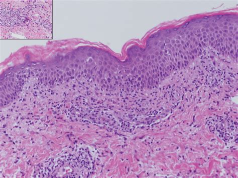 Erythematous Papules on the Scrotum, Trunk, and Extremities | MDedge Dermatology