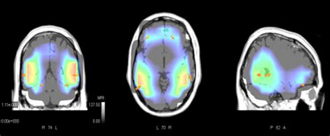 Temporal vs. spatial resolution in Functional Neuroimaging and what it ...