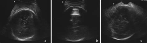 Asynclitism: Clinical and Intrapartum Diagnosis in Labor | Radiology Key