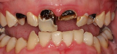 Rotten teeth: Causes, Symptoms, Treatment and Pictures