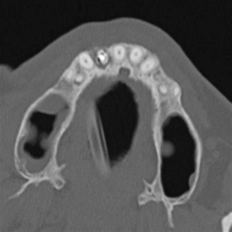 Periapical cyst | Radiology Case | Radiopaedia.org