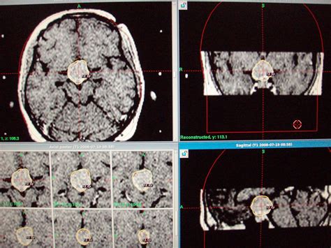 Pakistan Gamma Knife: Craniopharyngioma, complete resolution at one year follow up.