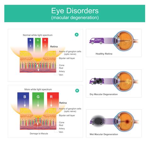 Retina Specialist Buffalo | Medical Retina NY | Surgical Retina