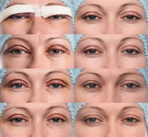 Exercise After Blepharoplasty ⋆ NinaTay.com