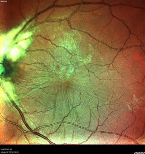 Macular Pucker With Myelinated Nerve Fiber Layer - Retina Image Bank