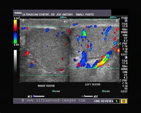 Ultrasound imaging: Orchitis- left testis