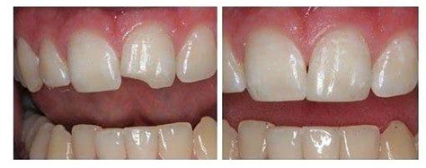 Repair-Chipped-Tooth | Partners in Dental Health