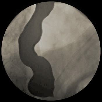 Another Complication of Peroral Endoscopic Myotomy | CTSNet