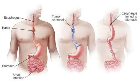 Esophagectomy (Esophageal Surgery) in Mumbai - Dr Shitesh Malewadkar